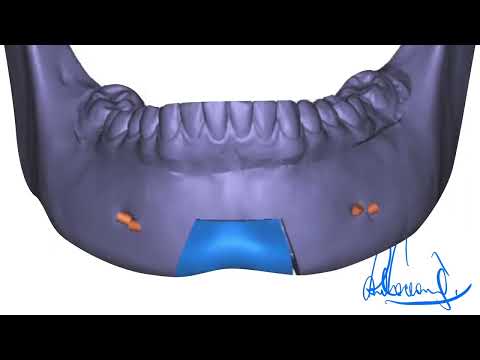 Chats With Docs - Episode 24 - asymmetric IMDO for asymmetric lower jaw