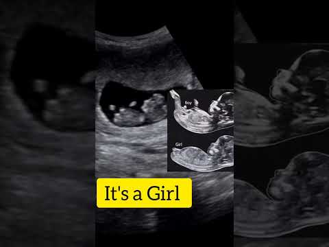 It's a baby girl: Nub Theory: Ultrasound case!!