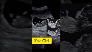 Download lagu It's a baby girl: Nub Theory: Ultrasound case!! mp3