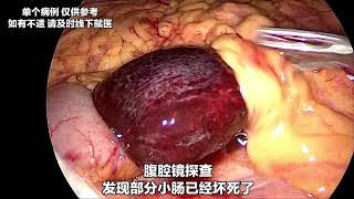 饭后剧烈运动，居然会导致肠管扭转？不及时复位要切肠子！