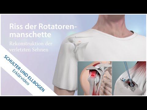 Rotator cuff tear