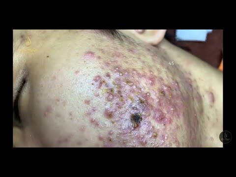 image-What are the grades of acne?