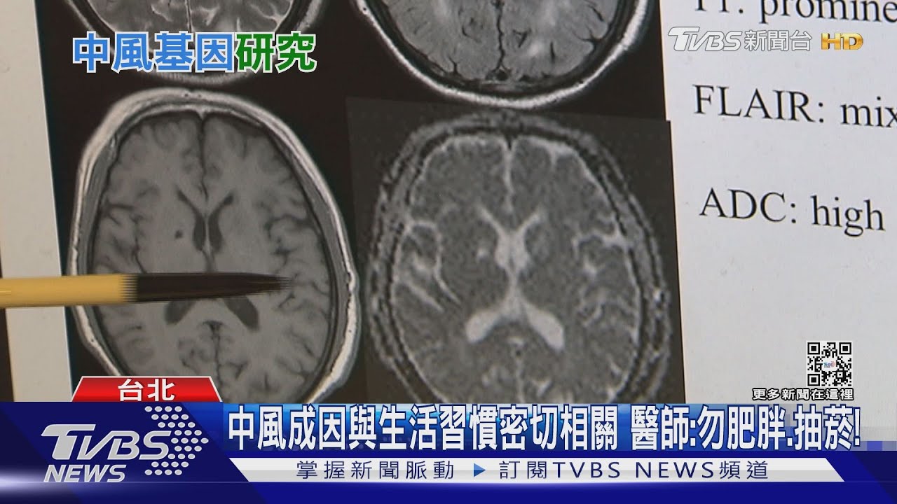 臺灣公衛學者廖勇柏 腦中風基因研究..「這個」重大突破關鍵...榮登Nature期刊!