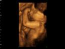 1st Video: 4D Ultrasound