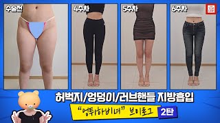[지방흡입] 허벅지 지방흡입 2탄! 허엉러
