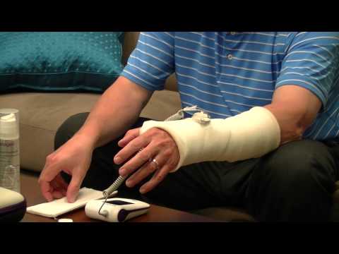 How to use your EXOGEN Ultrasound Bone Healing System with a Ported Cast