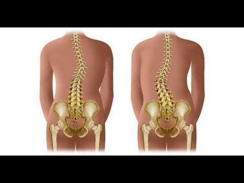 Упражнения для профилактики плоскостопия и осанки в доу Искривление позвоночника и кишечник