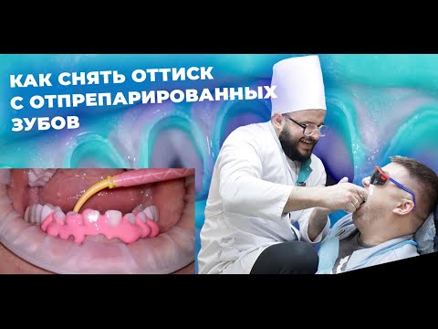 Как снять оттиск с отпрепарированных зубов
