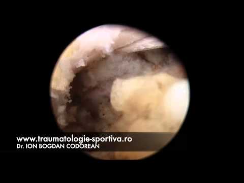 Luxație acromio-claviculară