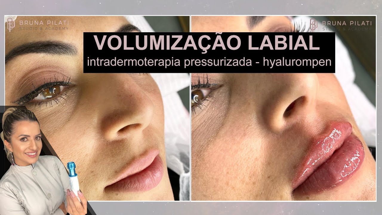 Intradermoterapia Pressurizada, Hyaluronpen, Volumização Labial, Bruna Pilati
