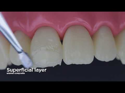 [ENG] Restoration of anterior tooth with composite.