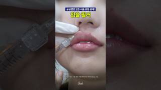 입술 리프트 성형 시술
