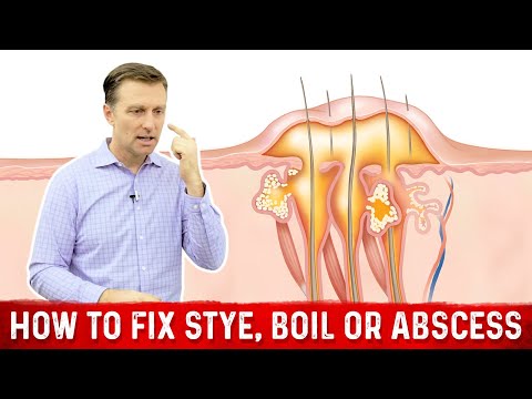 The Deeper Cause of an Eye Stye, Boil or Abscess – Eye Infection Stye – Dr.Berg