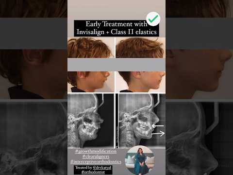 Mixed dentition Class 2 and overjet correction with invisalign using elastics #orthodontics #dentist