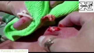 Top cystic acne, blackheads, acne horror squeeze in 2015 - Pamela T Brumfield