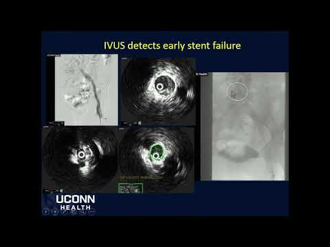 Iliac compression syndrome, IVUS guided stenting (Volcano Philips)