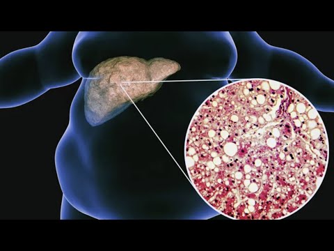 "Metabolic Dysfunction-Associated Steatotic Liver Disease – Diagnosis & Treatment Updates"