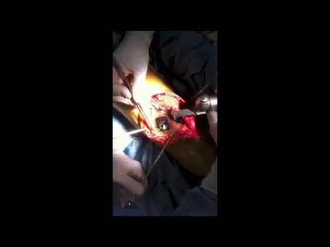 Neoplasia nel polso Mal di schiena e il mughetto