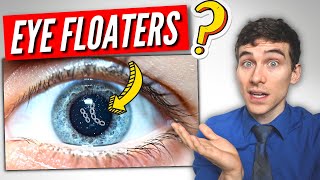 3 Must Know Facts About Visual Floaters!