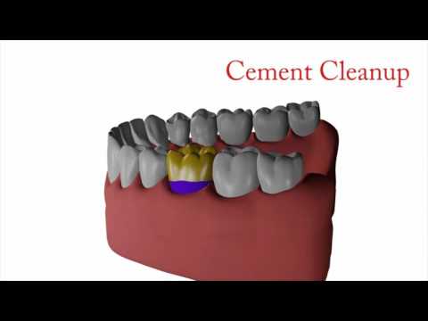 Adjustable Magic Strip System