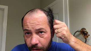 Hair Replacement Hair System Review Poly System take off and clean up