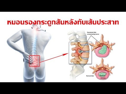 ระลอกในหน้าอกที่เพิ่มขึ้น หน้าอกน้อยกว่า 3 เดือน