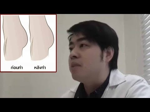 การรักษาโรคสะเก็ดเงินบนเล็บ แม่ neurodermatitis พยาบาล