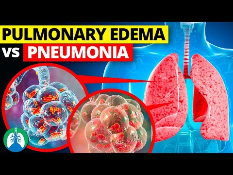 Pulmonary Edema vs. Pneumonia