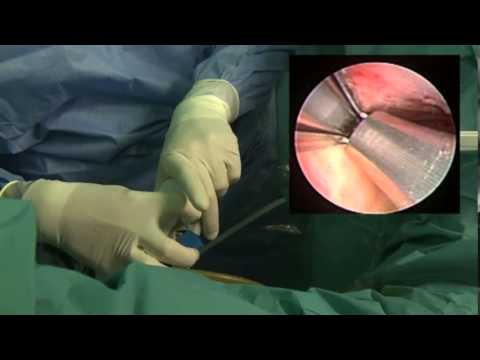 Minimalnie inwazyjne rozszerzenie cewki sterczowej z wykorzystaniem implantu UroLift