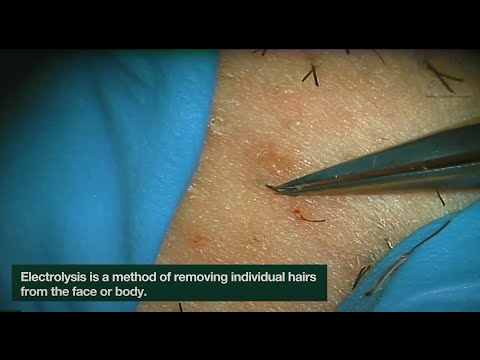 Electrolysis Ingrown Hair Removal | CLOSEUP | Here is how Electrolysis works! | Jade Clinics