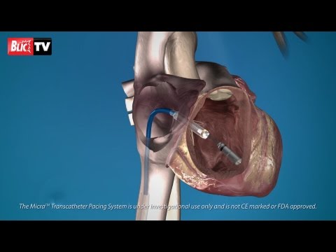 Ugradnja i prednosti novog pejsmejkera