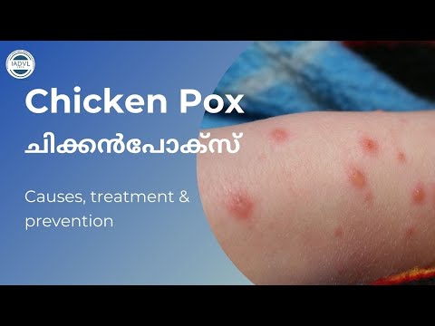 IADVL KERALA ചർമ്മാരോഗ്യം - Chickenpox