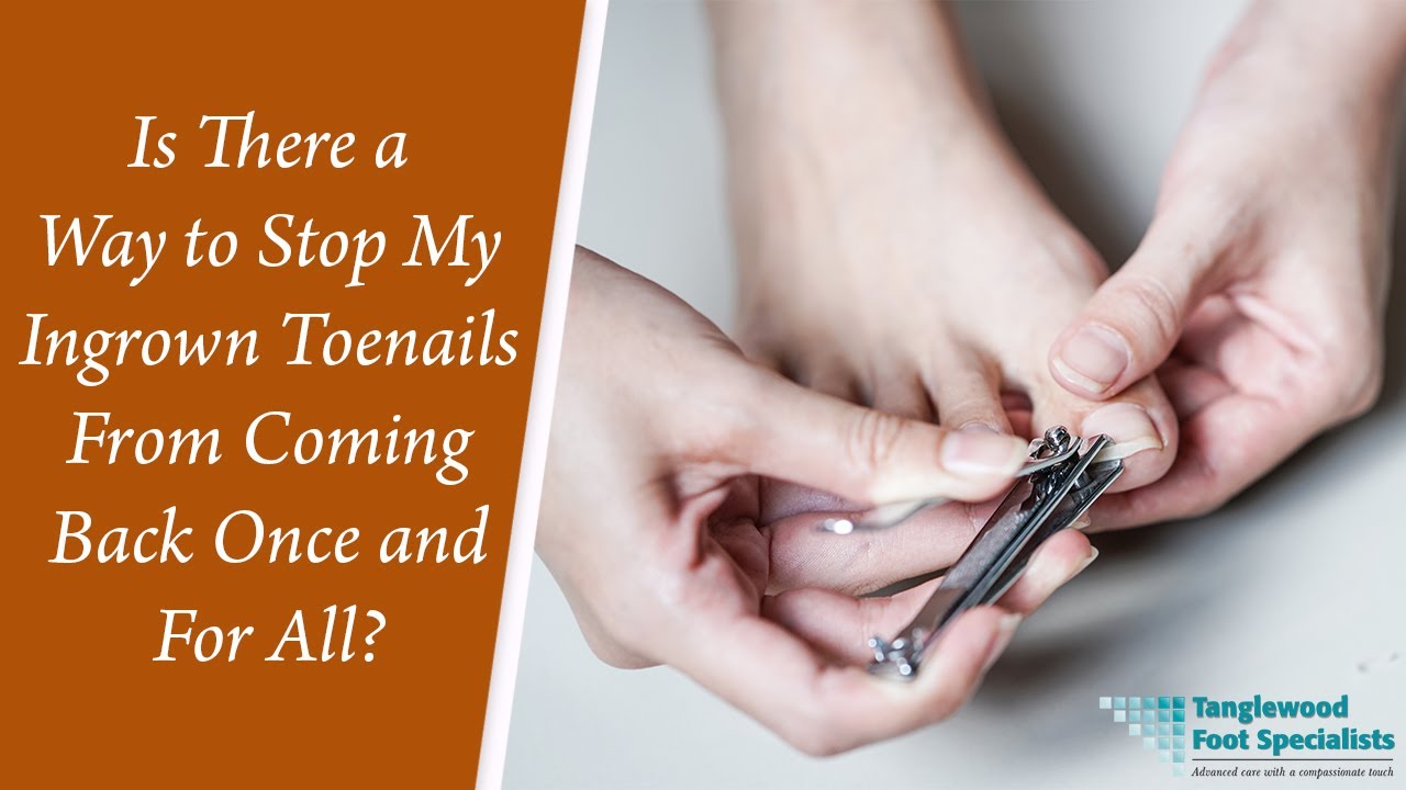 Is There a Way to Stop My Ingrown Toenails From Coming Back Once and For All?