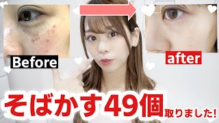 【⚠️必見】シミ・そばかすをレーザーで取ってきました♩ダウンタイム・経過報告なども♩₍ᐢ⸝⸝› ‹⸝⸝ᐢ₎【ピコレーザー】