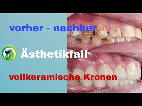 Vorher nachher Ästhetikfall mit vollkeramischen Kronen - Zirkon vollverblendet - metallfrei