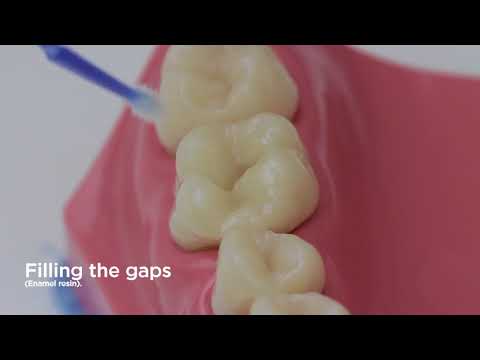 Preclinical Dentistry - Posterior Restoration
