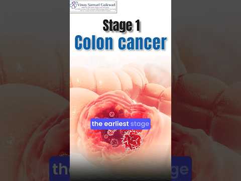 Stage 1 Colon Cancer(What You Should Know) #coloncancer