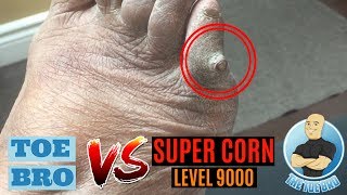 PAINFUL FOOT CORN REMOVAL & TIPS TO STOP FOOT CORNS!!!