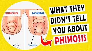 #1 PHIMOSIS: Foreskin too tight to pull back... why and how can i treat it?