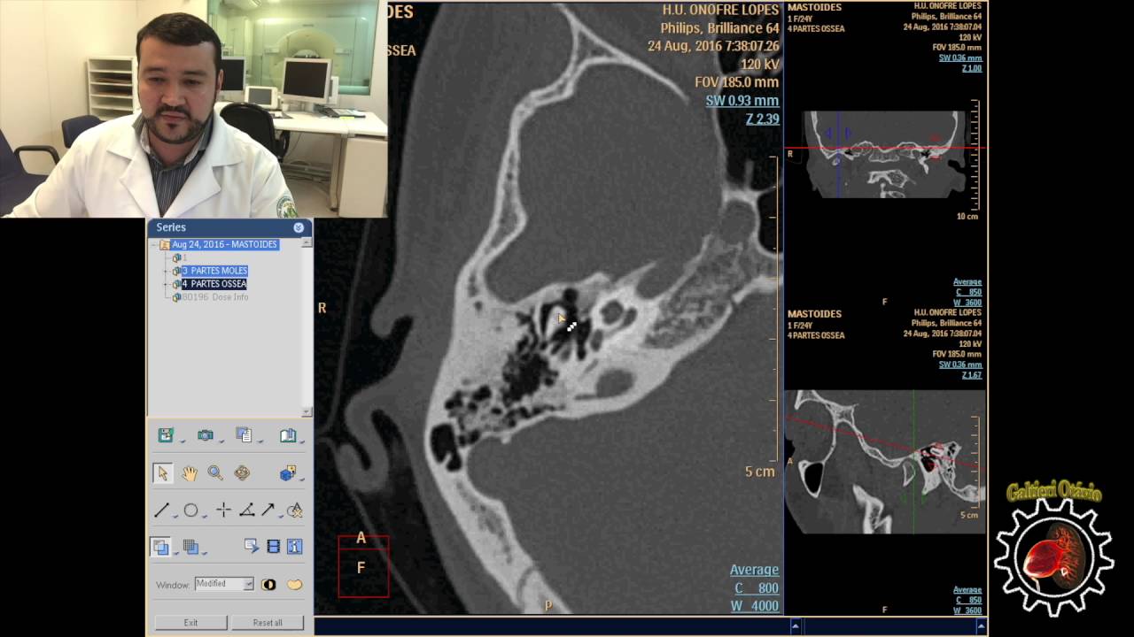TOMOGRAFIA DAS MASTOIDES - PASSO A PASSO DA DOMUMENTAÇÃO