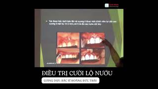 [Học chỉnh nha] - Điều trị cười lộ nướu. Giảng dạy bác sĩ Hoàng Đức Thái. #niengrang #dentist
