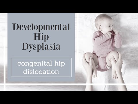 Developmental Hip Dysplasia - congenital hip dislocation