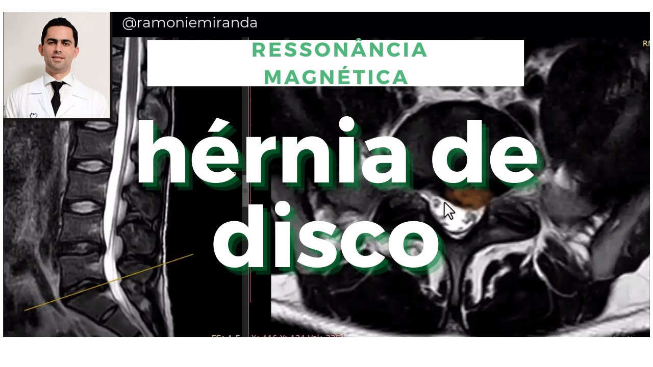 Hérnia de Disco Lombar: Ressonância Magnética (caso)