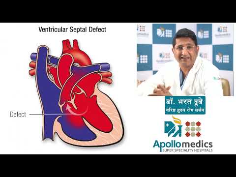 बच्चों में ASD/VSD(दिल में छेद)से न घबराये जानिए Dr Bharat Dubey|Apollo Hospitals Lucknow के जुबानी।