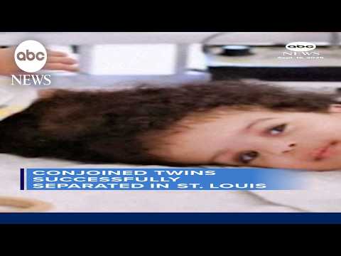 Conjoined twins successfully separated in St. Louis