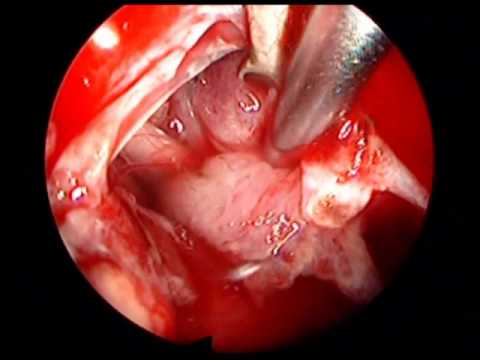 Pituitary Adenoma And Aneurysm