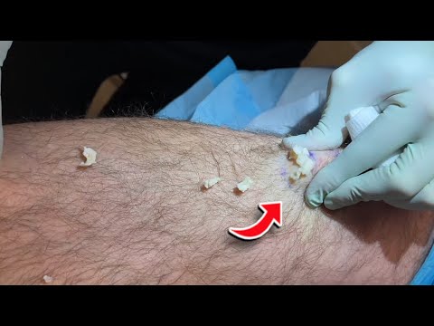 ARE THESE THE BEST PIMPLE POPS OF 2022?! | 5 New Pimple Popping Videos 2022