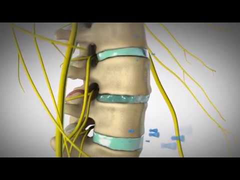 Nowoczesna małoinwazyjna metoda leczenia przepukliny kręgosłupa.