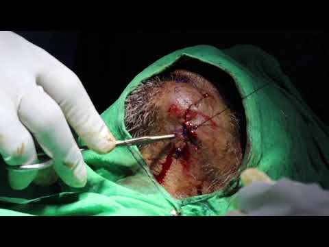 SUTURING IN AYURVEDA