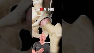 Shocking Look At Hip Arthritis Damage⁉️